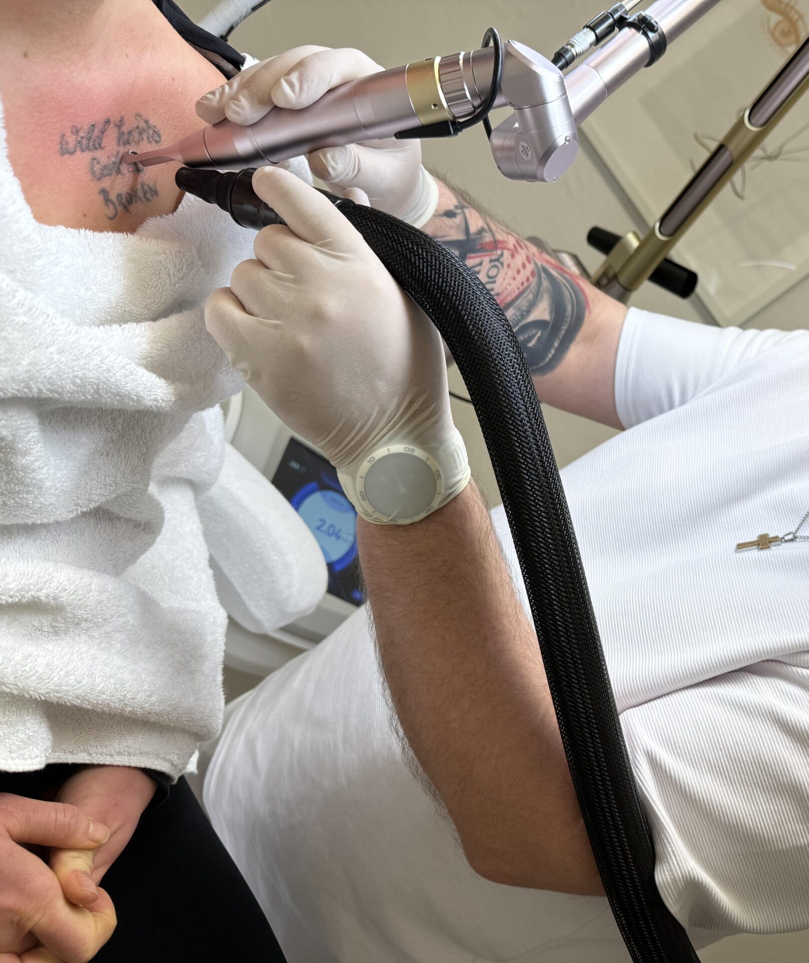 Tattoo- und PMU-Entfernung St. Gallen