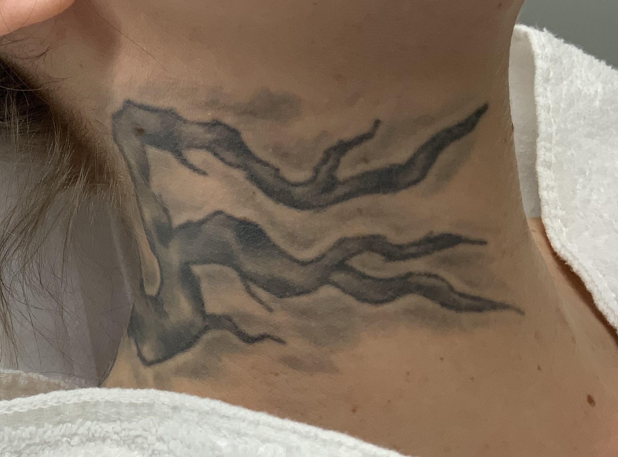 Tattooentfernung Behandlung