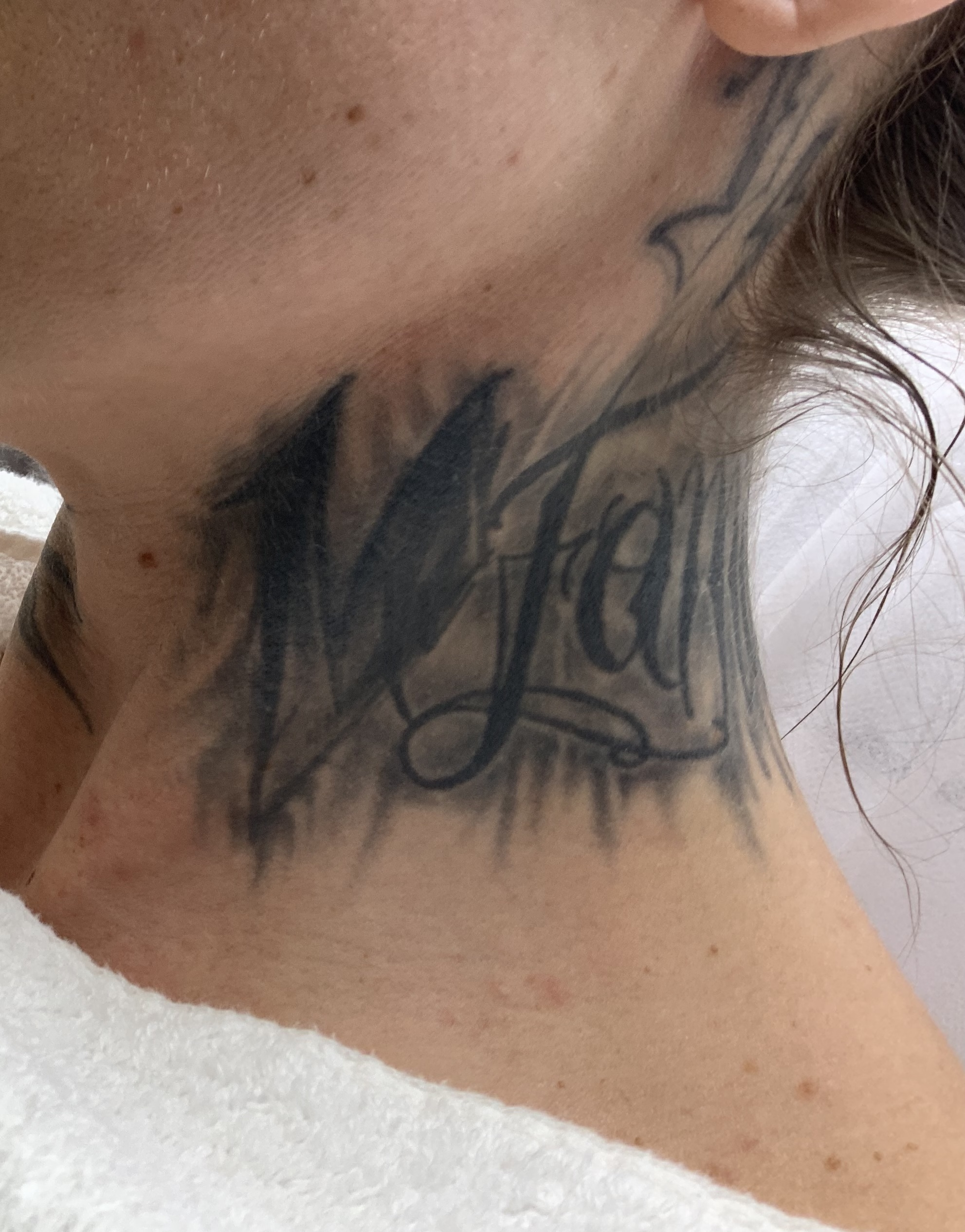 Tattooentfernung Behandlung