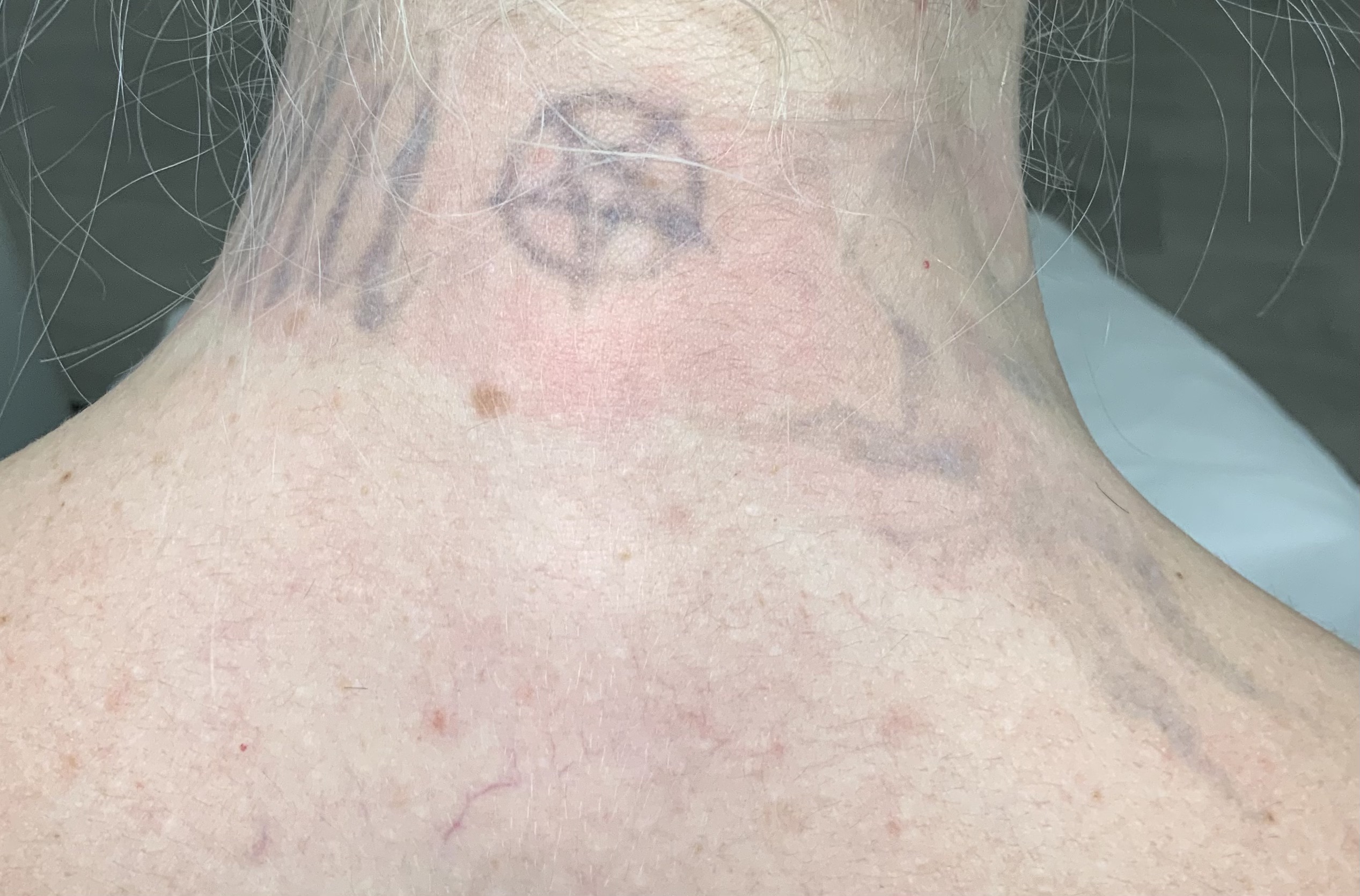 Tattooentfernung Ergebnis