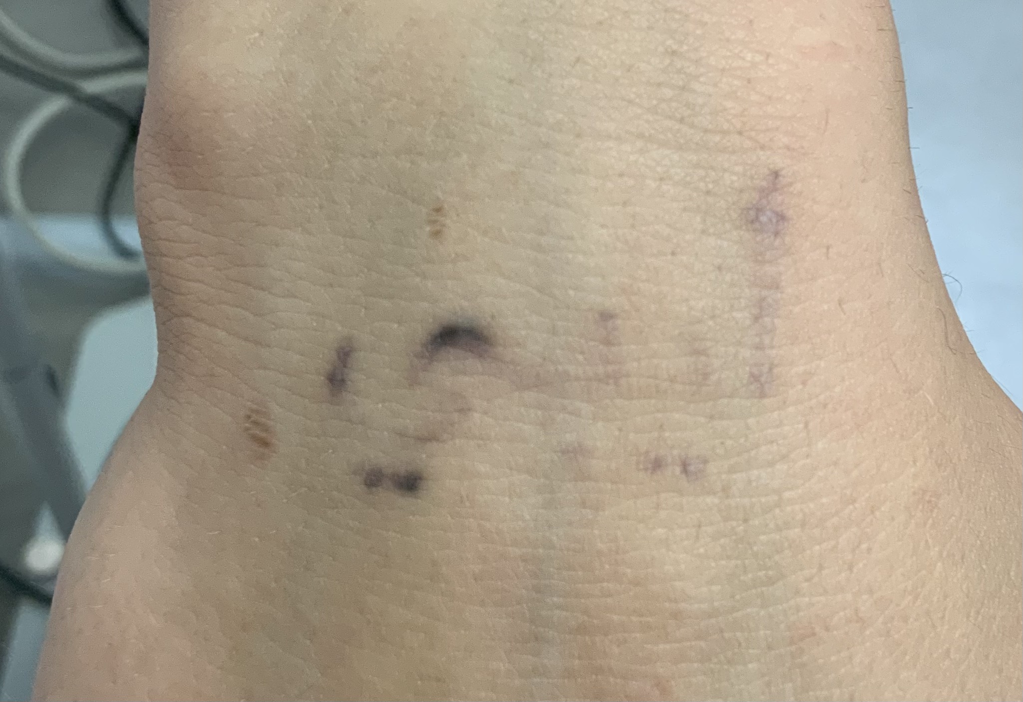Tattooentfernung nach mehreren Sitzungen