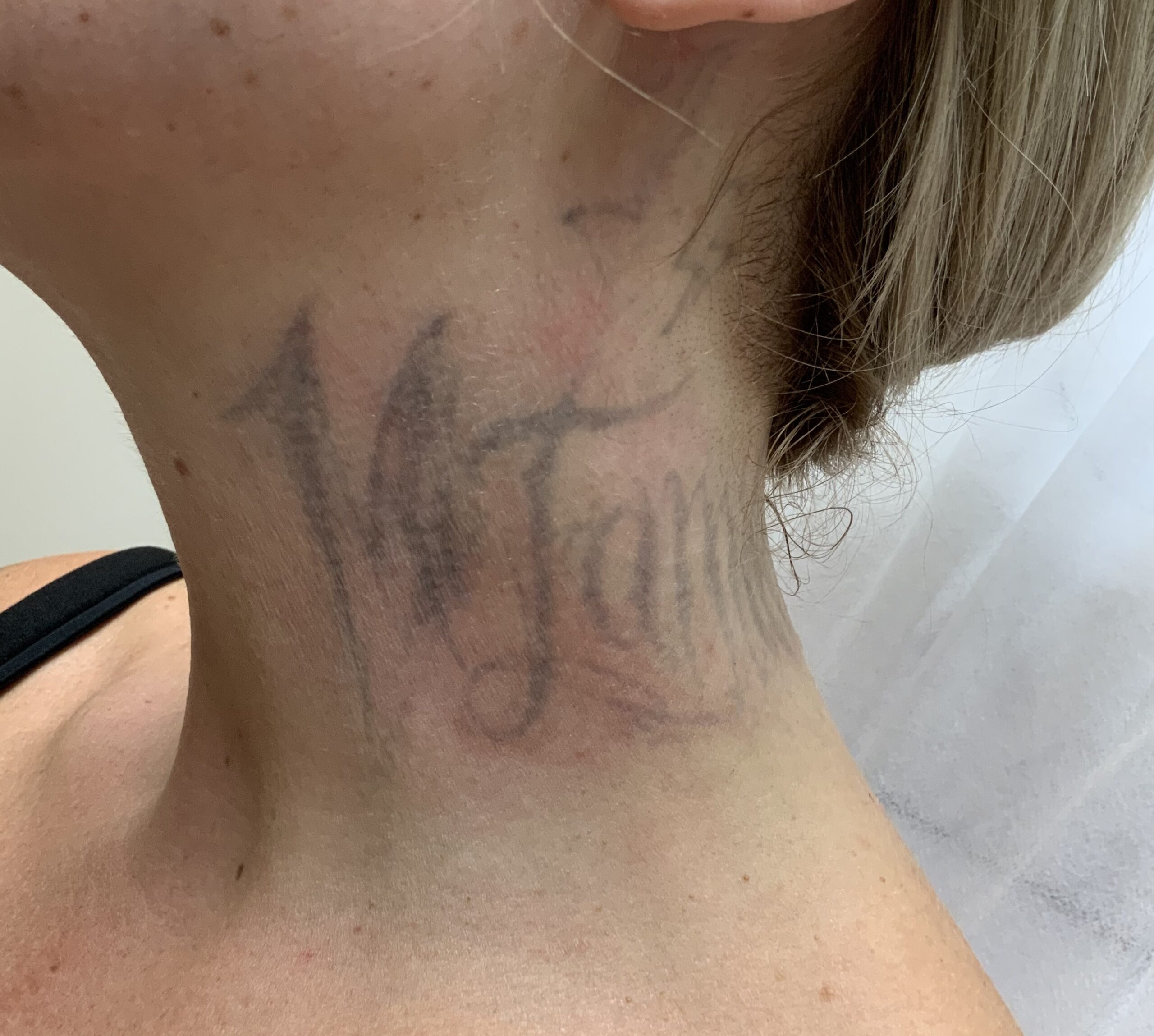 Hals Tattoo Entfernung Stand nach 13 Sitzungen