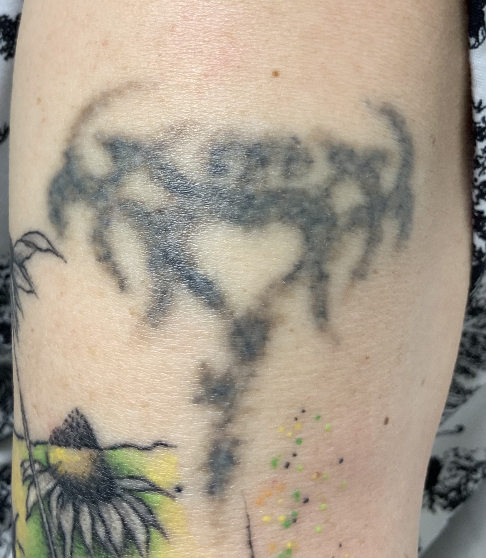 Älteres Tattoo nach einer Sitzung der Tattooentfernung