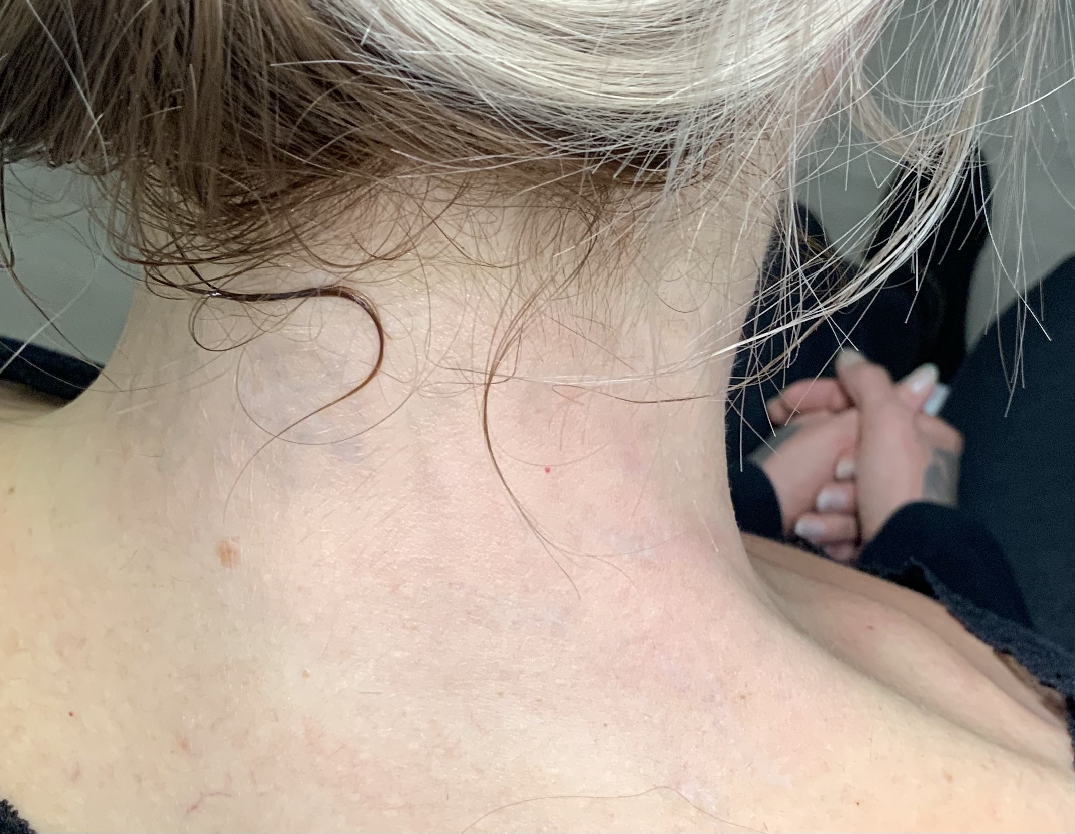 Hals-Tattoo nach 14 Sitzungen