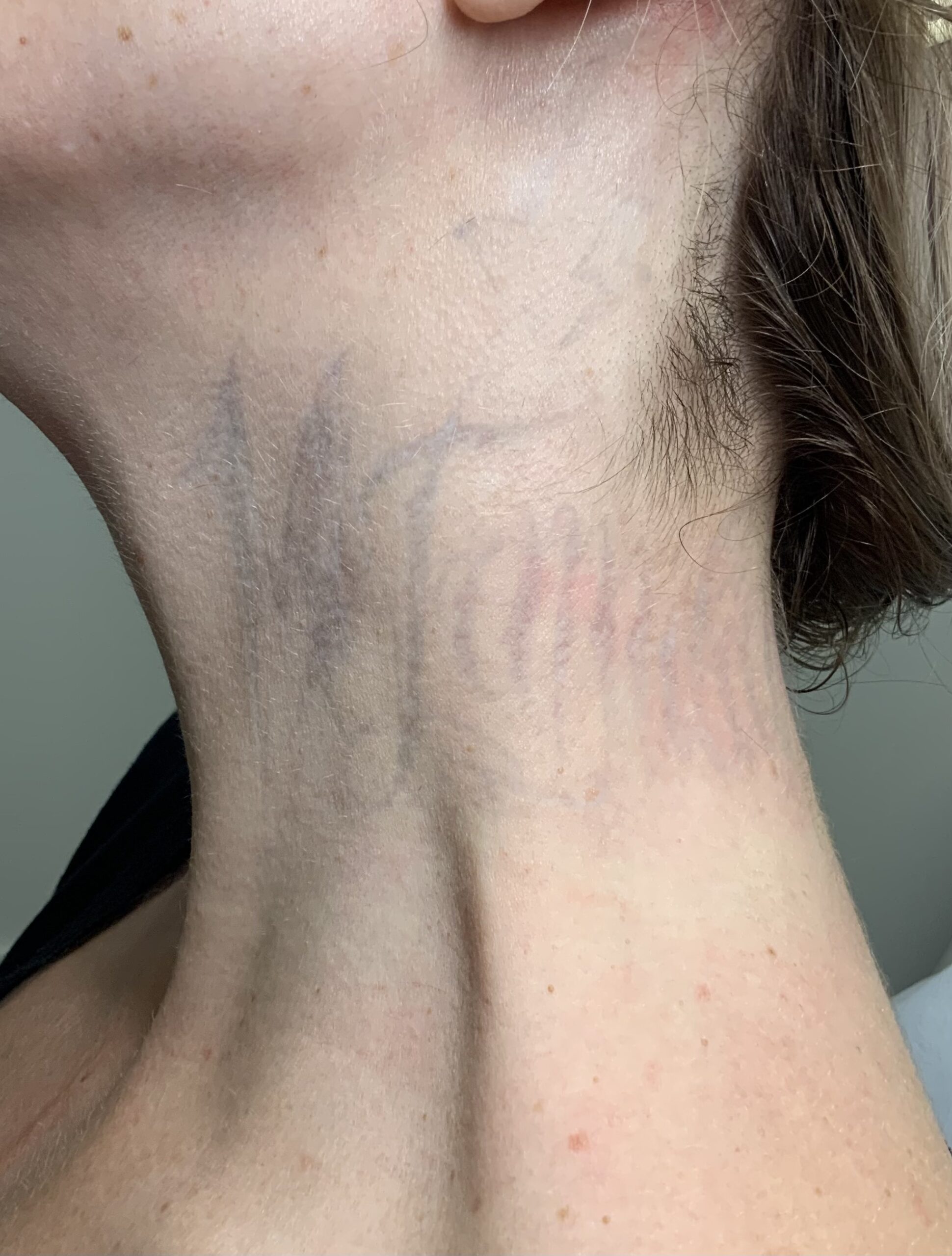 Hals Tattoo Entfernung Stand nach 14 Sitzungen